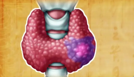 什么样,的,甲状腺结节,要,引起,重视,